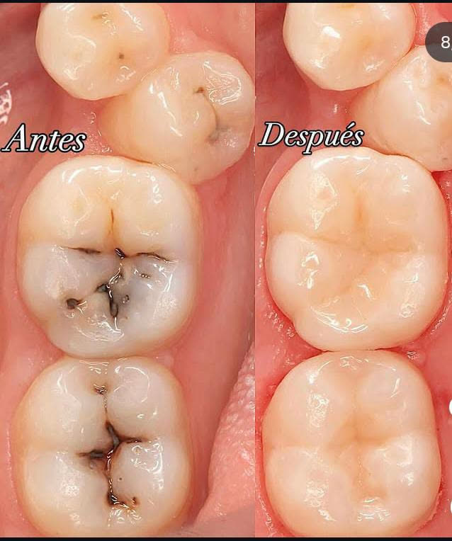 Curación estética con resina: antes y después