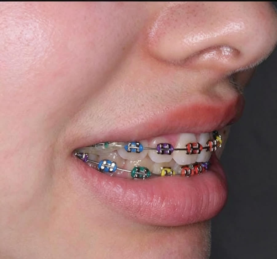 Brackets de colores