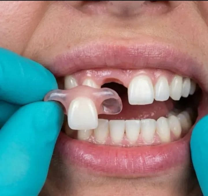 Prótesis dental con diente de reemplazo