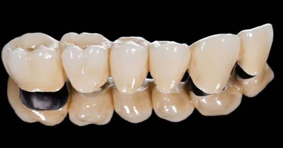 Puente dental de porcelana